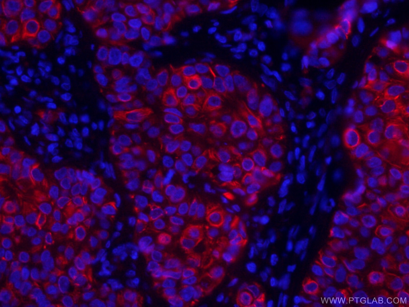 Immunofluorescence (IF) / fluorescent staining of human breast cancer tissue using CoraLite®594-conjugated TNF Alpha Monoclonal antib (CL594-60291)