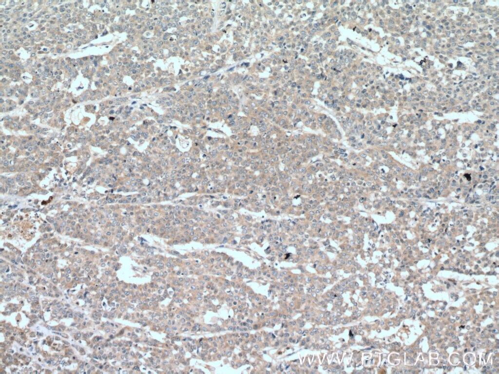 Immunohistochemistry (IHC) staining of human colon cancer tissue using TNFAIP1 Monoclonal antibody (60327-1-Ig)