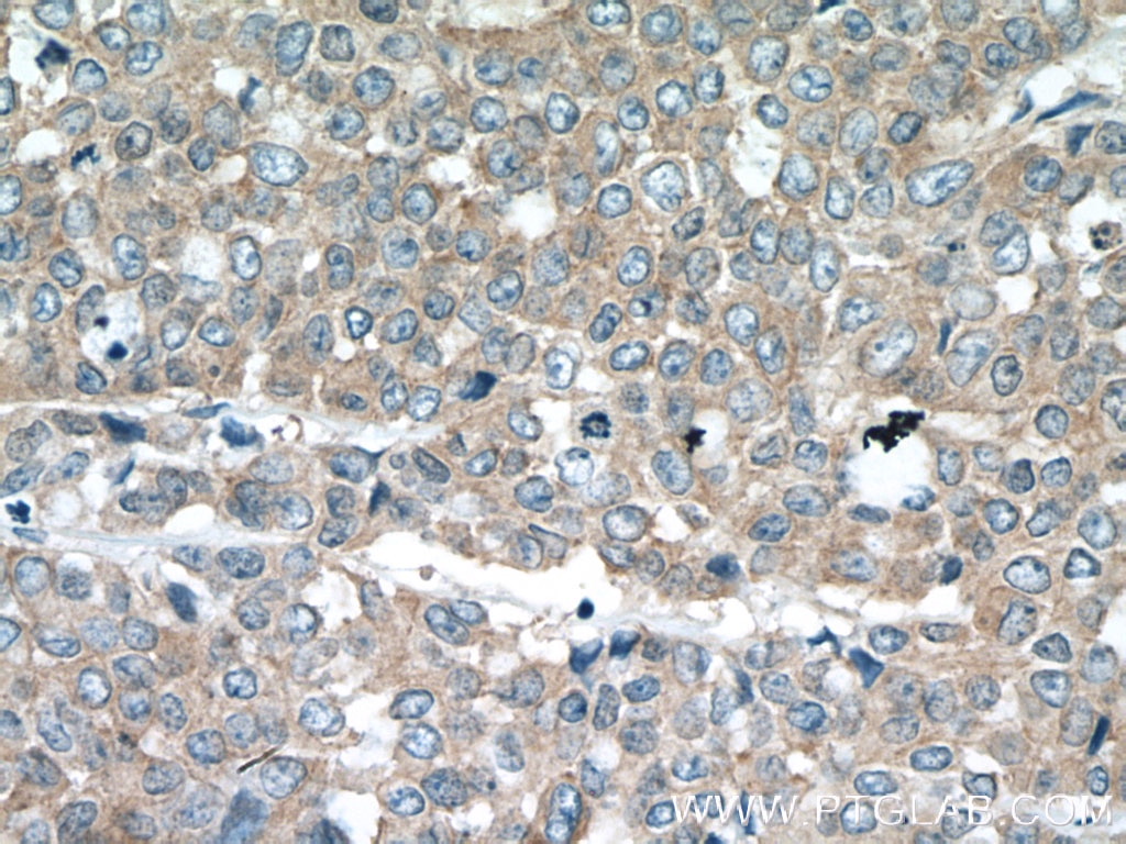 Immunohistochemistry (IHC) staining of human colon cancer tissue using TNFAIP1 Monoclonal antibody (60327-1-Ig)