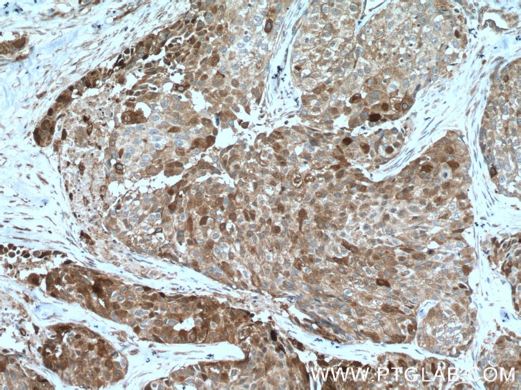 Immunohistochemistry (IHC) staining of human lung cancer tissue using TNFAIP1 Monoclonal antibody (60327-1-Ig)