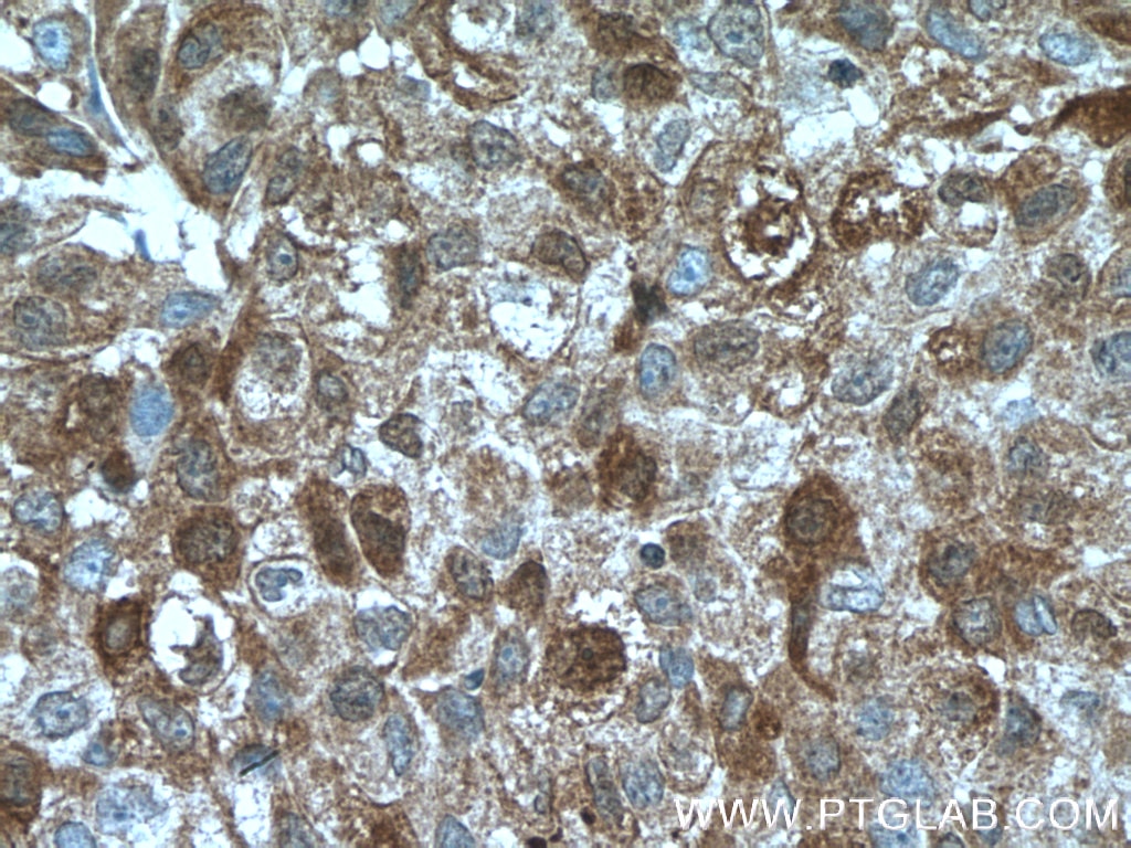 Immunohistochemistry (IHC) staining of human lung cancer tissue using TNFAIP1 Monoclonal antibody (60327-1-Ig)