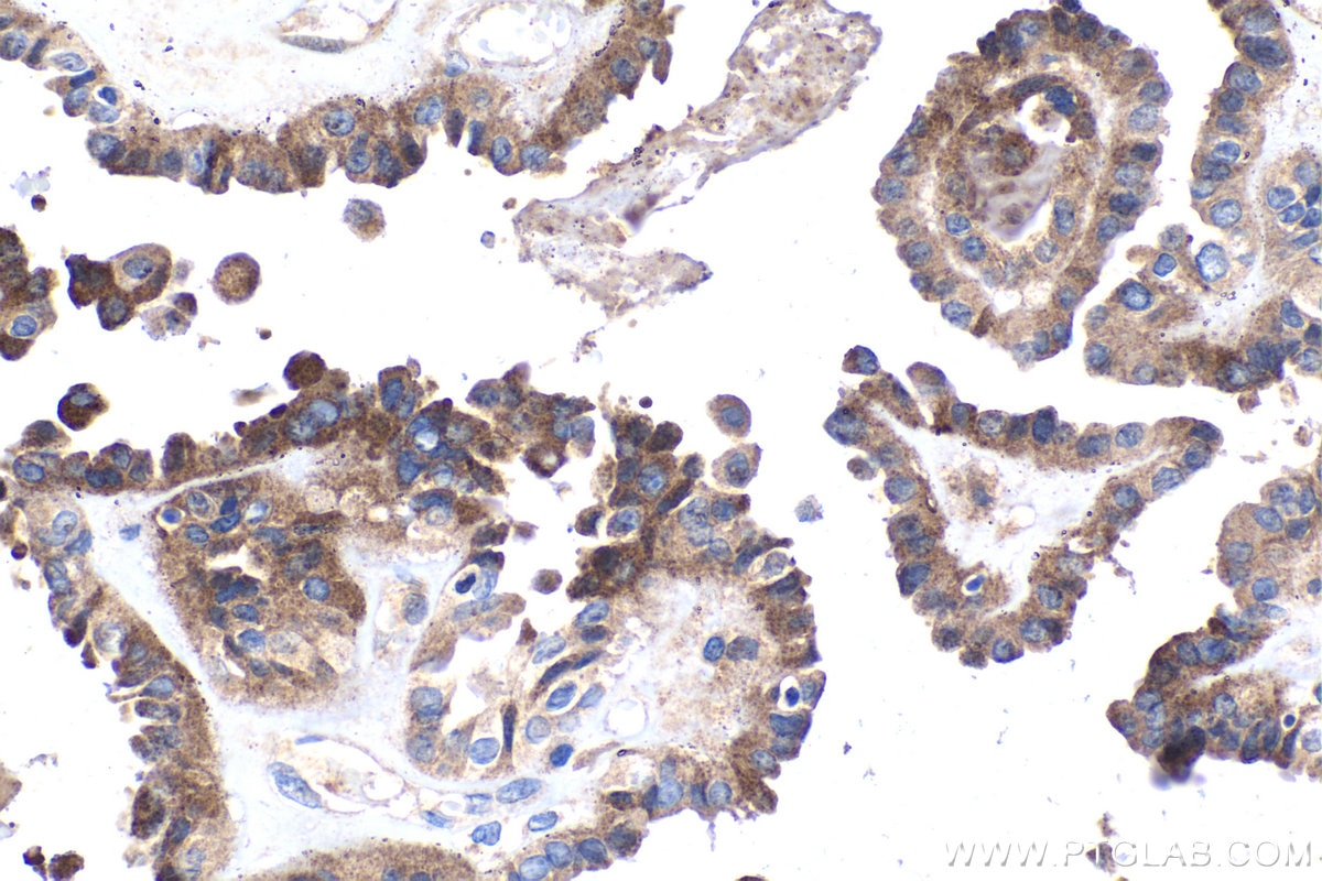 Immunohistochemistry (IHC) staining of human thyroid cancer tissue using TNFAIP3 Monoclonal antibody (66695-1-Ig)