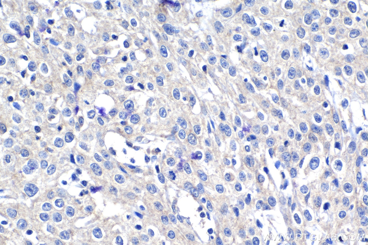 Immunohistochemistry (IHC) staining of human cervical cancer tissue using TSG-6 Polyclonal antibody (13321-1-AP)