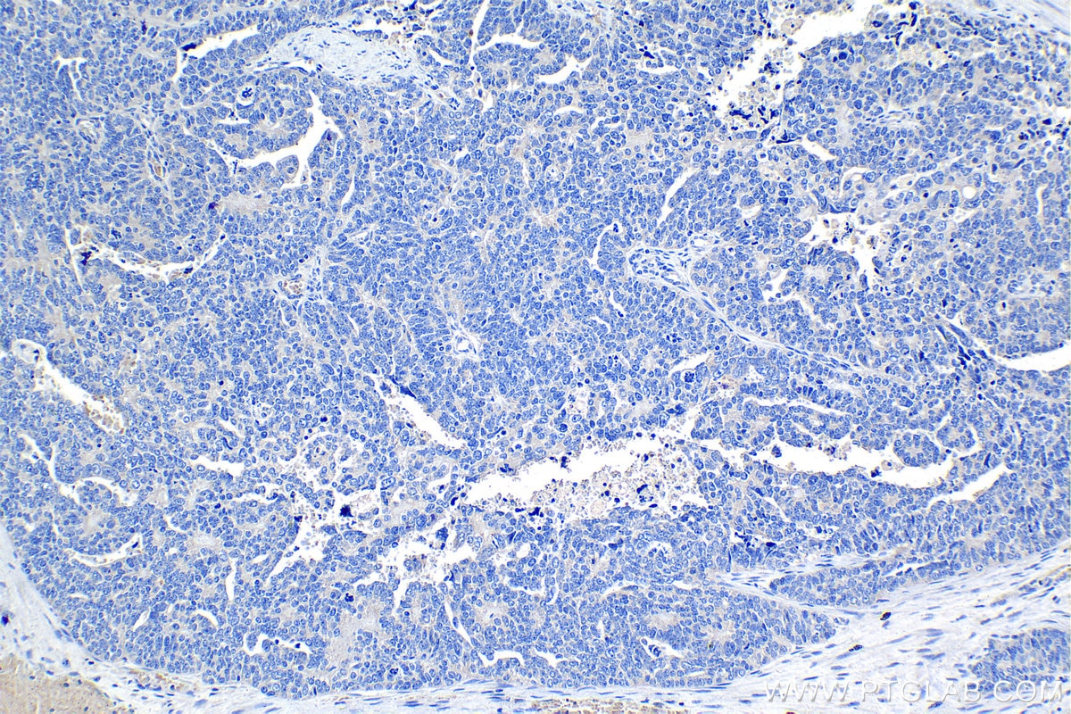Immunohistochemistry (IHC) staining of human ovary tumor tissue using TSG-6 Polyclonal antibody (13321-1-AP)
