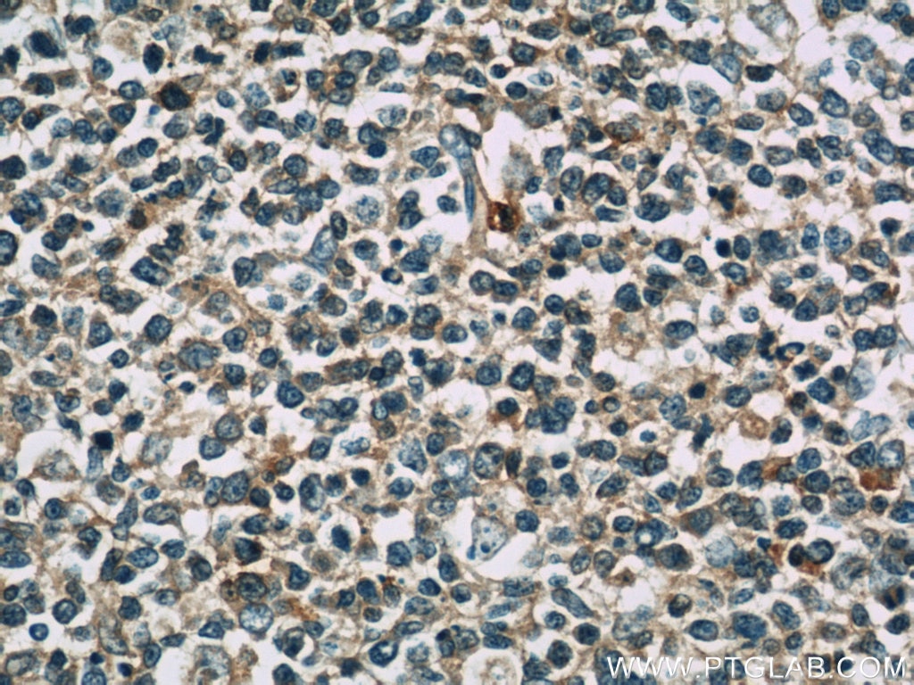 Immunohistochemistry (IHC) staining of human tonsillitis tissue using TNFAIP8 Polyclonal antibody (15790-1-AP)