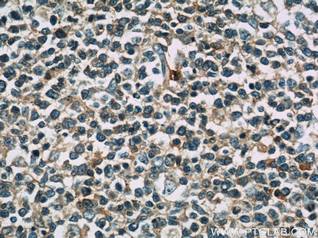 IHC staining of human tonsillitis using 15790-1-AP