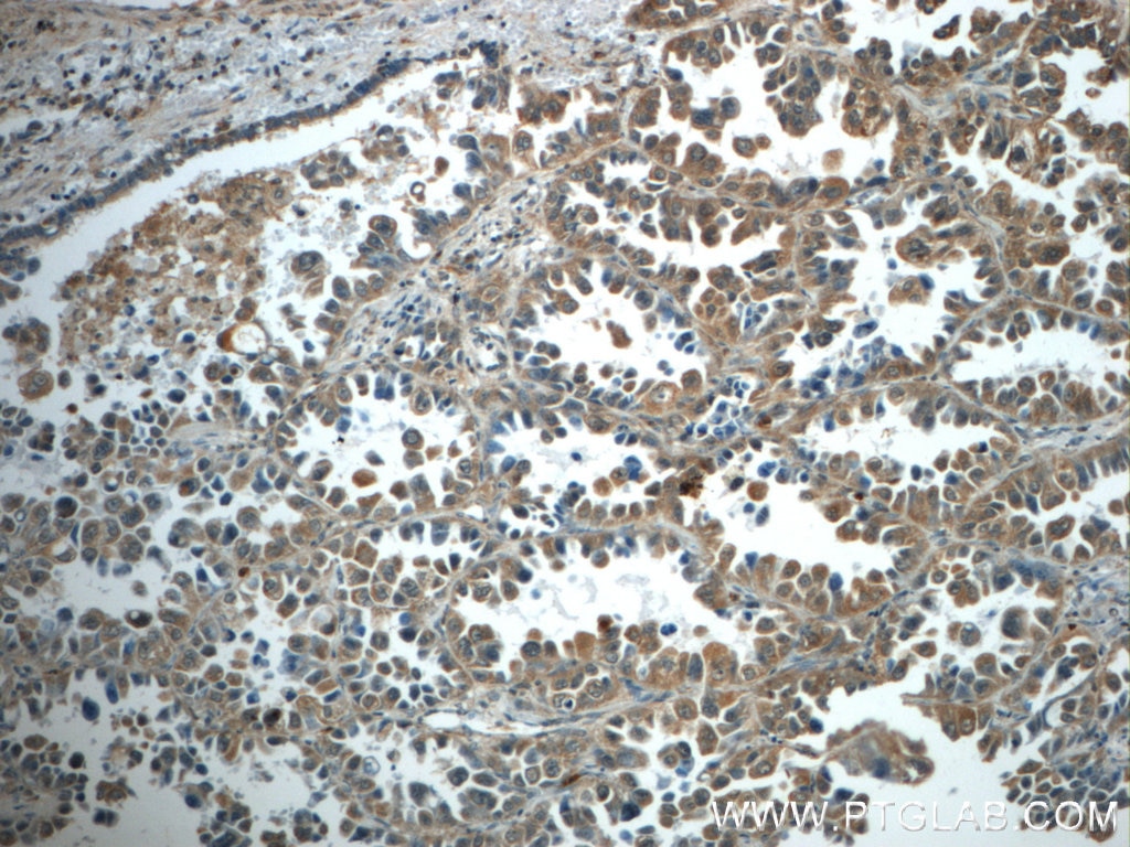 Immunohistochemistry (IHC) staining of human lung cancer tissue using TNFAIP8 Polyclonal antibody (15790-1-AP)