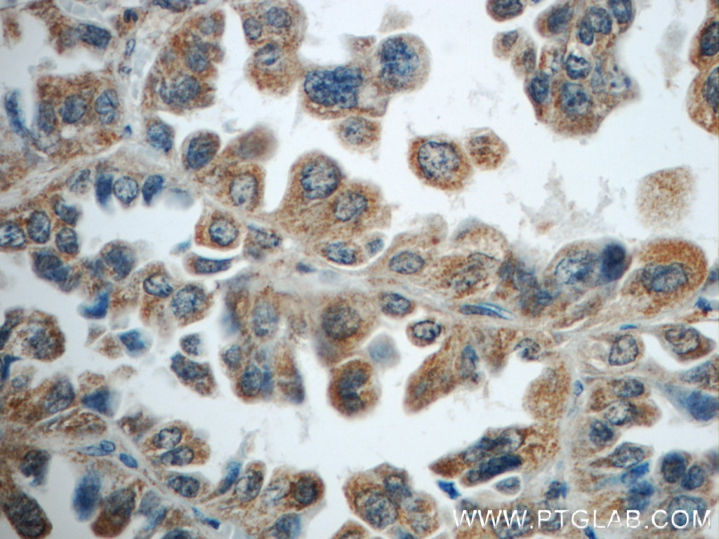 Immunohistochemistry (IHC) staining of human lung cancer tissue using TNFAIP8 Polyclonal antibody (15790-1-AP)