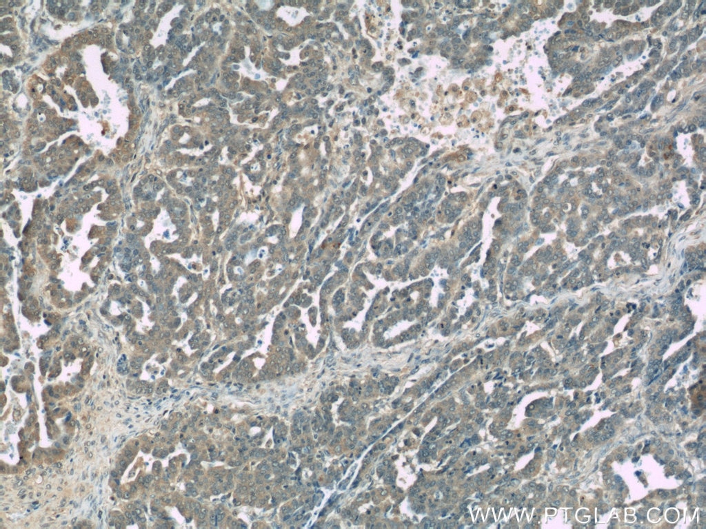 IHC staining of human ovary tumor using 15940-1-AP