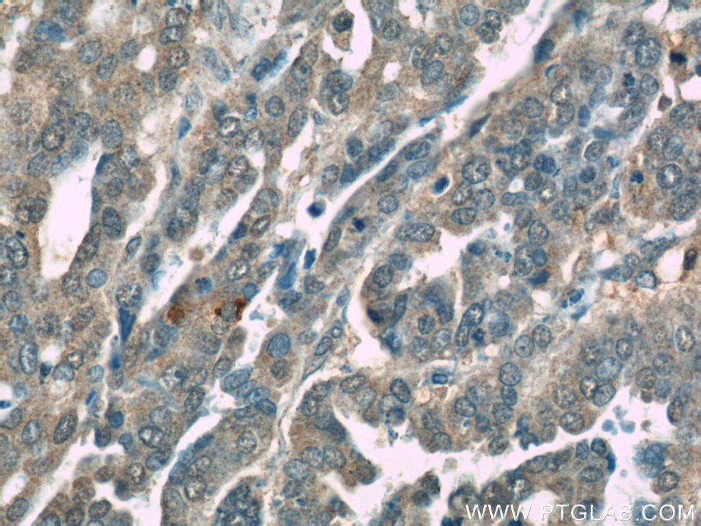 Immunohistochemistry (IHC) staining of human ovary tumor tissue using TIPE2 Polyclonal antibody (15940-1-AP)