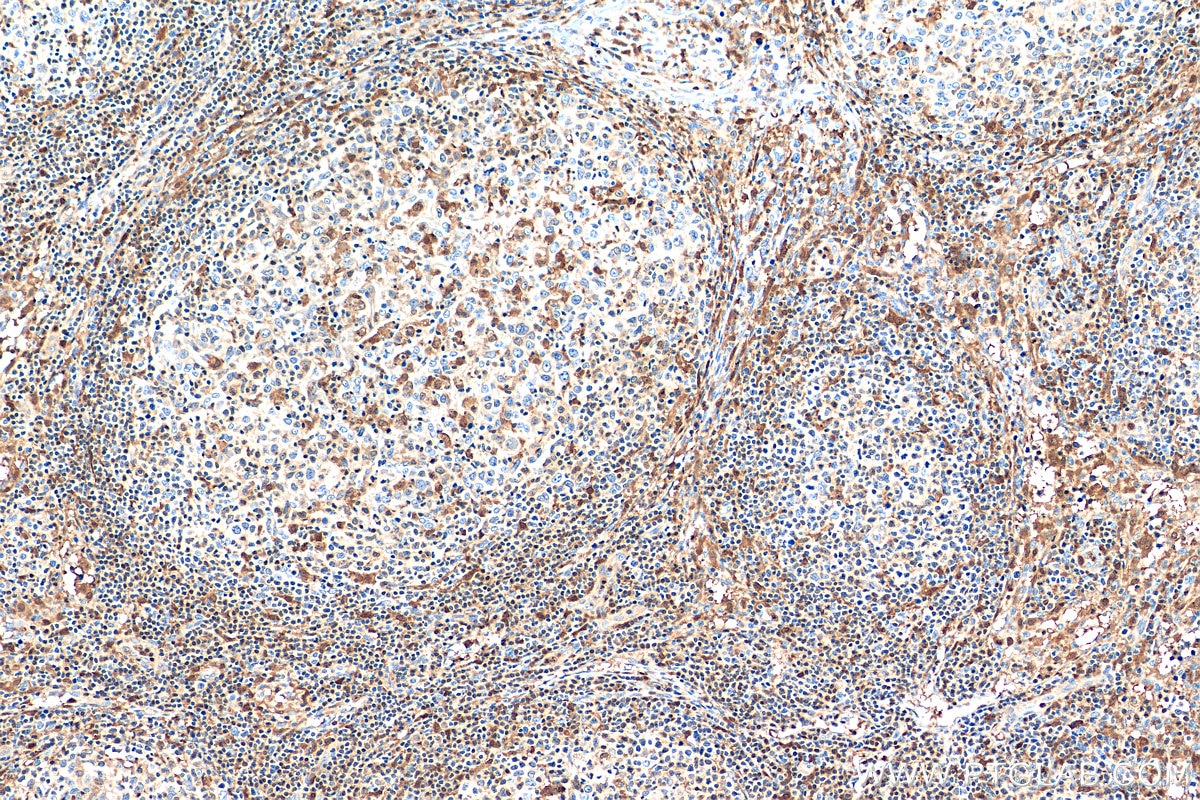 Immunohistochemistry (IHC) staining of human lymphoma tissue using TIPE2 Polyclonal antibody (15940-1-AP)