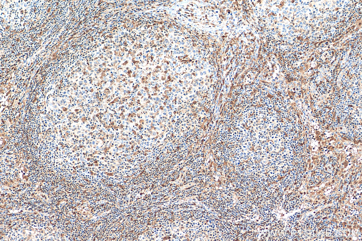 Immunohistochemistry (IHC) staining of human lymphoma tissue using TIPE2 Polyclonal antibody (15940-1-AP)