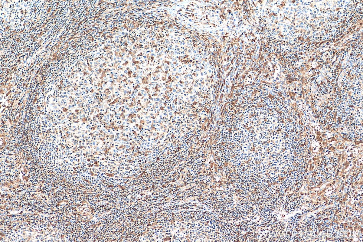 IHC staining of human lymphoma using 15940-1-AP