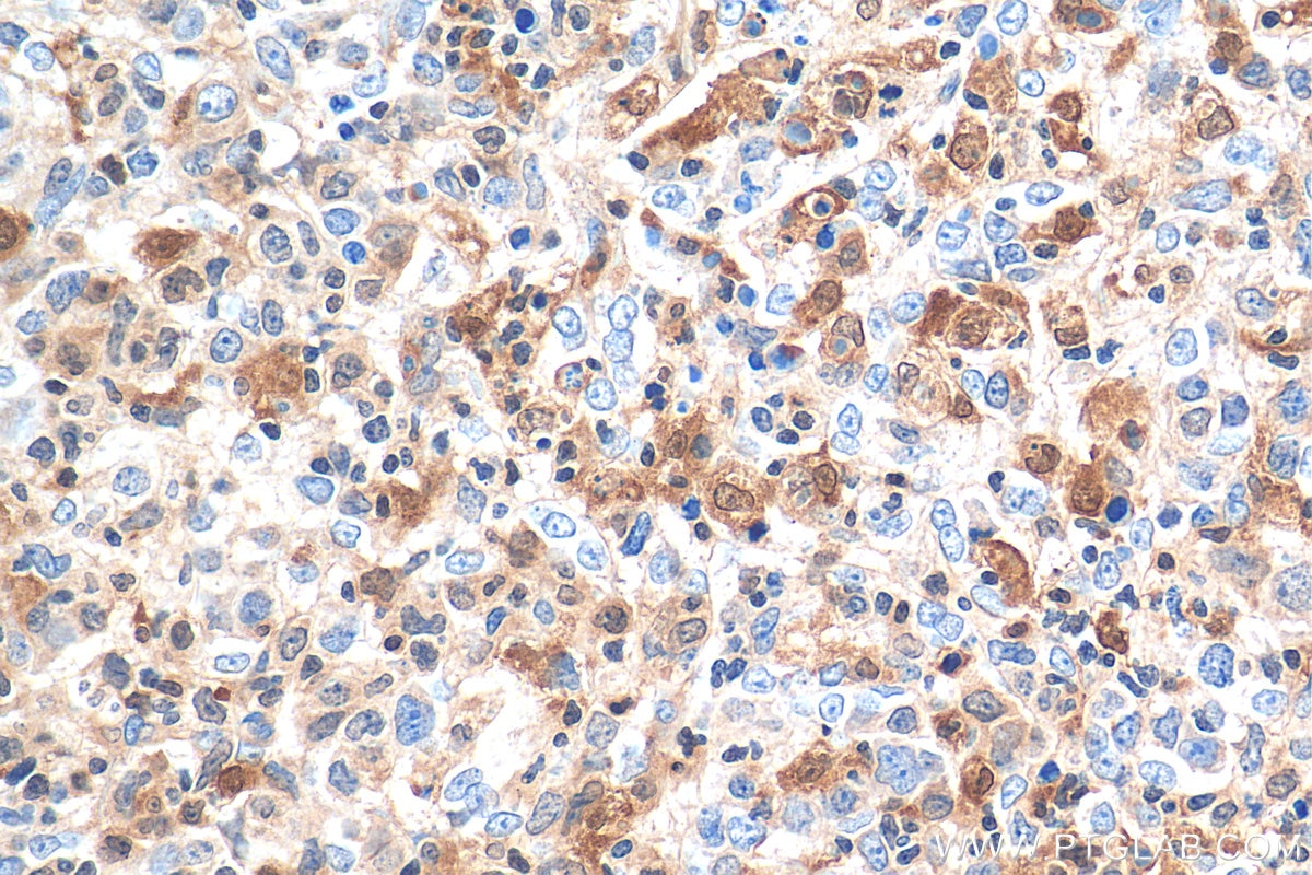 Immunohistochemistry (IHC) staining of human lymphoma tissue using TIPE2 Polyclonal antibody (15940-1-AP)
