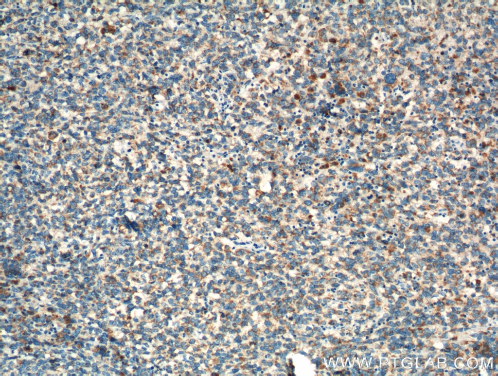 Immunohistochemistry (IHC) staining of human malignant melanoma tissue using TNF Beta Polyclonal antibody (13111-1-AP)