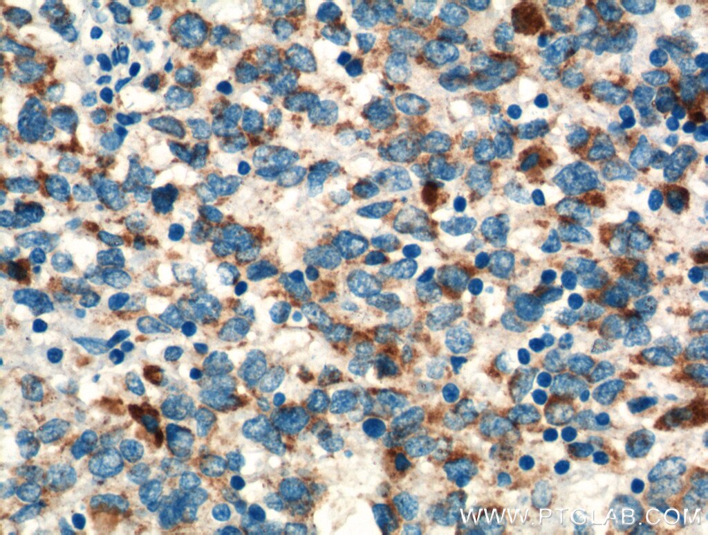 Immunohistochemistry (IHC) staining of human malignant melanoma tissue using TNF Beta Polyclonal antibody (13111-1-AP)