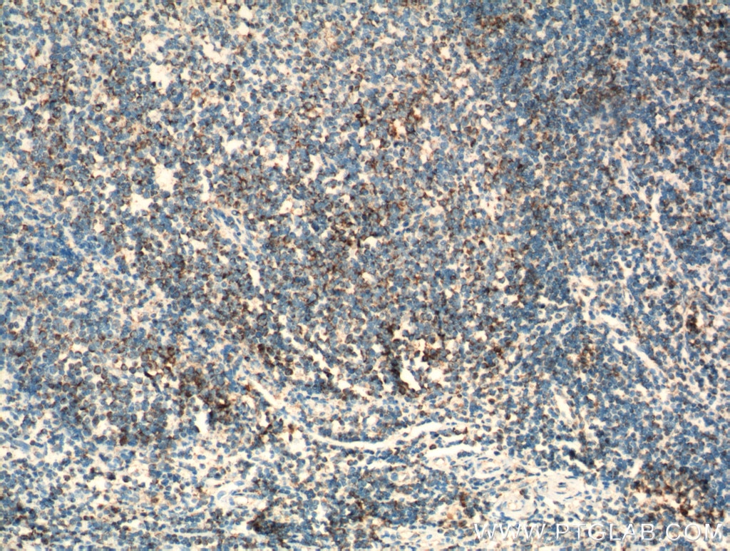 Immunohistochemistry (IHC) staining of human tonsillitis tissue using TNF Beta Polyclonal antibody (13111-1-AP)