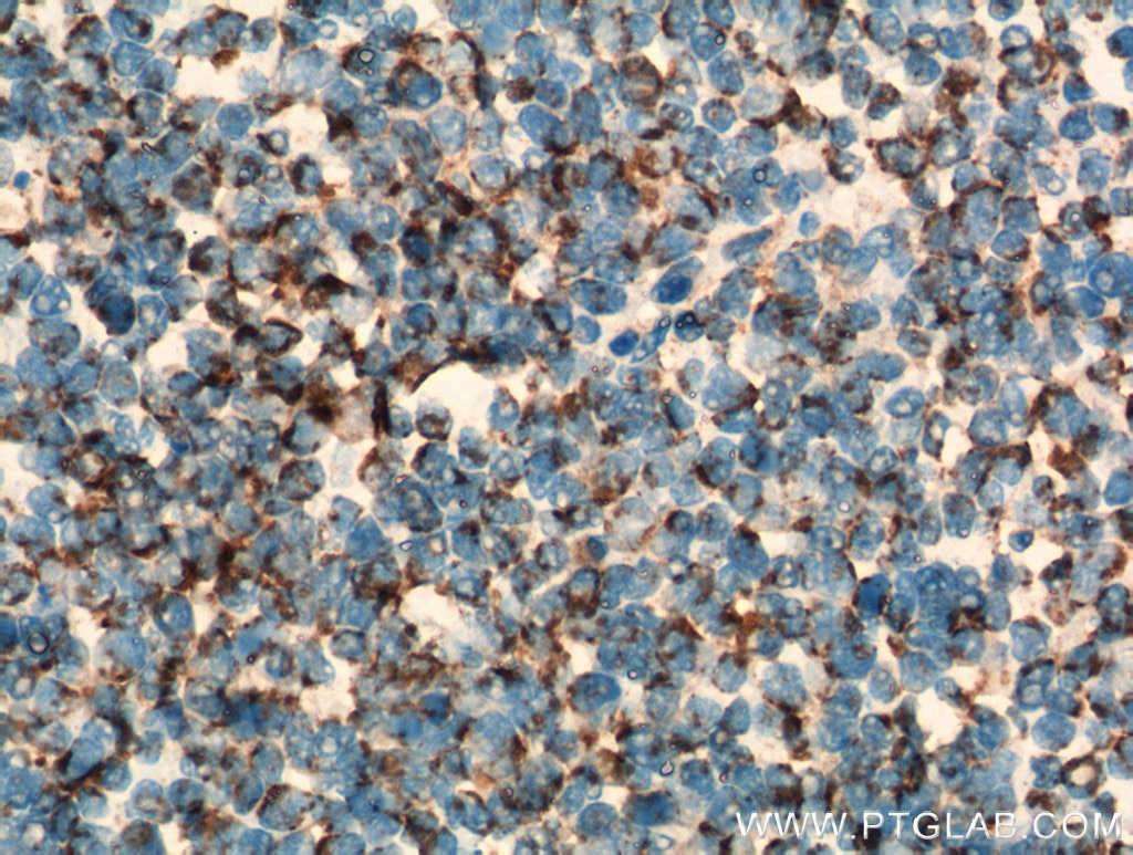 Immunohistochemistry (IHC) staining of human tonsillitis tissue using TNF Beta Polyclonal antibody (13111-1-AP)