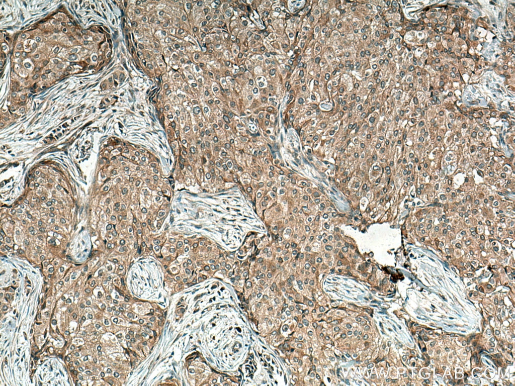 Immunohistochemistry (IHC) staining of human breast cancer tissue using TNFR1 Polyclonal antibody (21574-1-AP)