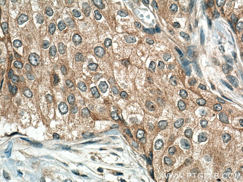 Immunohistochemistry (IHC) staining of human breast cancer tissue using TNFR1 Polyclonal antibody (21574-1-AP)