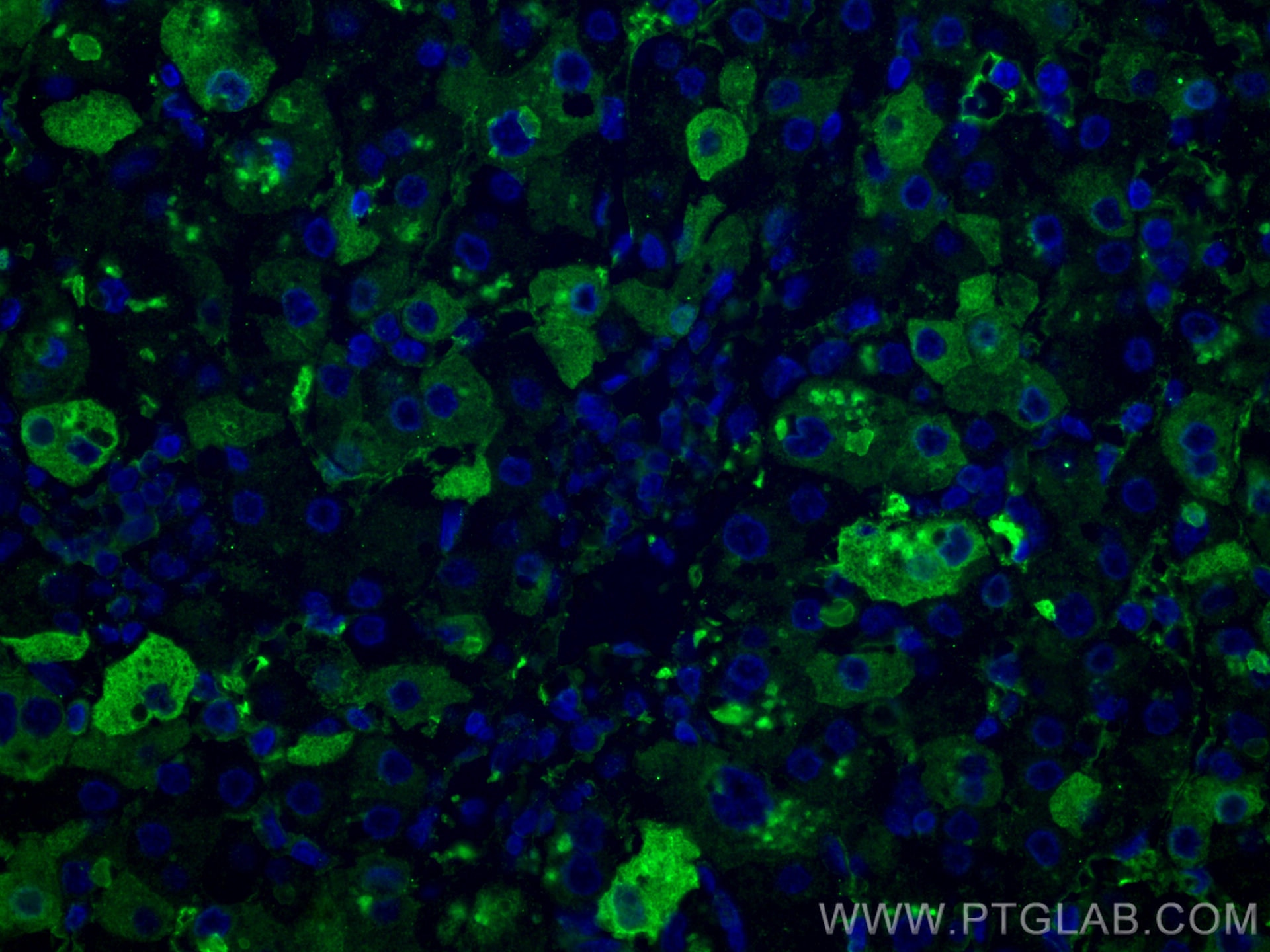 Immunofluorescence (IF) / fluorescent staining of human liver cancer tissue using TNFR1 Monoclonal antibody (60192-1-Ig)