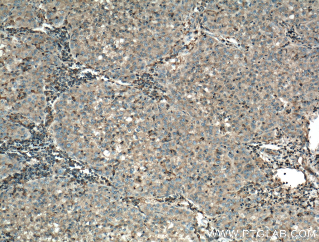 Immunohistochemistry (IHC) staining of human liver cancer tissue using TNFR1 Monoclonal antibody (60192-1-Ig)