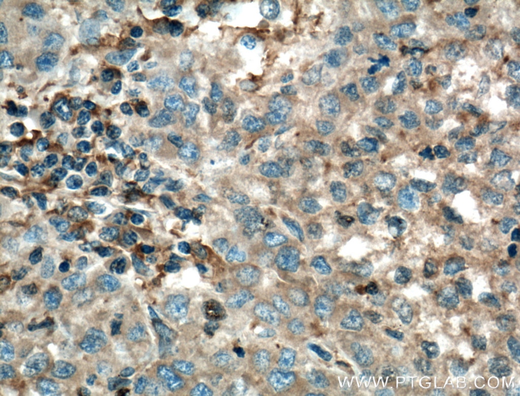Immunohistochemistry (IHC) staining of human liver cancer tissue using TNFR1 Monoclonal antibody (60192-1-Ig)