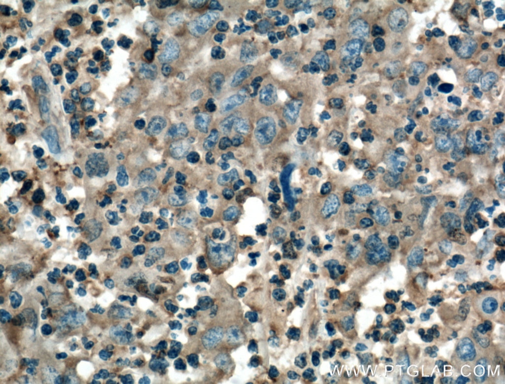 Immunohistochemistry (IHC) staining of human colon cancer tissue using TNFR1 Monoclonal antibody (60192-1-Ig)