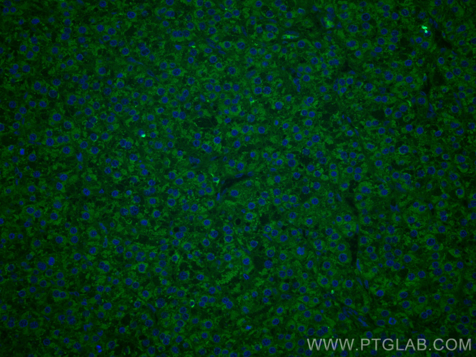 Immunofluorescence (IF) / fluorescent staining of human liver cancer tissue using CoraLite® Plus 488-conjugated TNFR1 Monoclonal ant (CL488-60192)