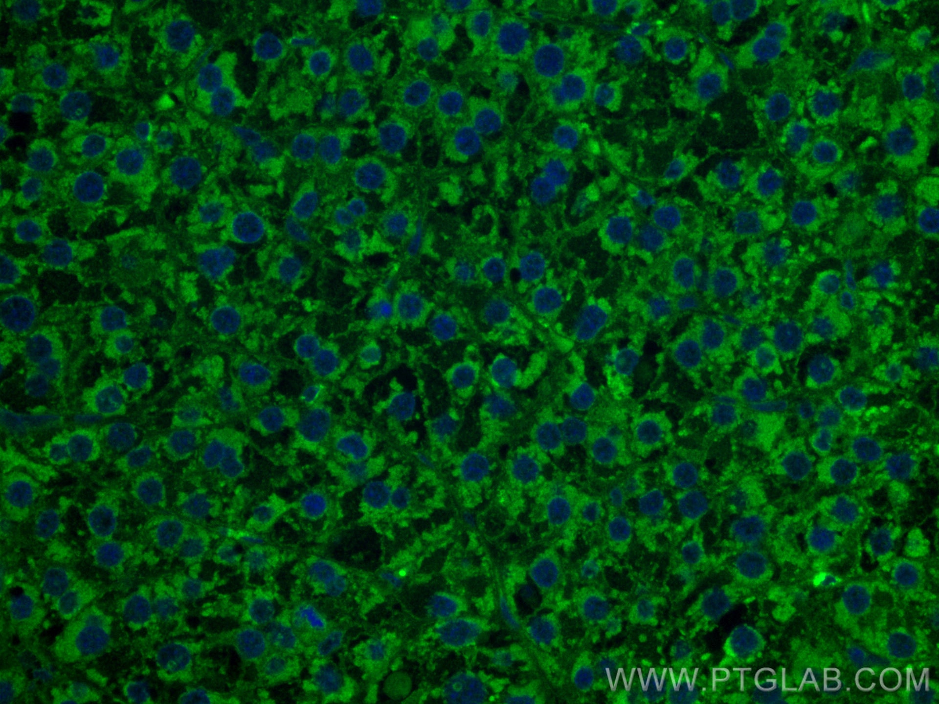 Immunofluorescence (IF) / fluorescent staining of human liver cancer tissue using CoraLite® Plus 488-conjugated TNFR1 Monoclonal ant (CL488-60192)