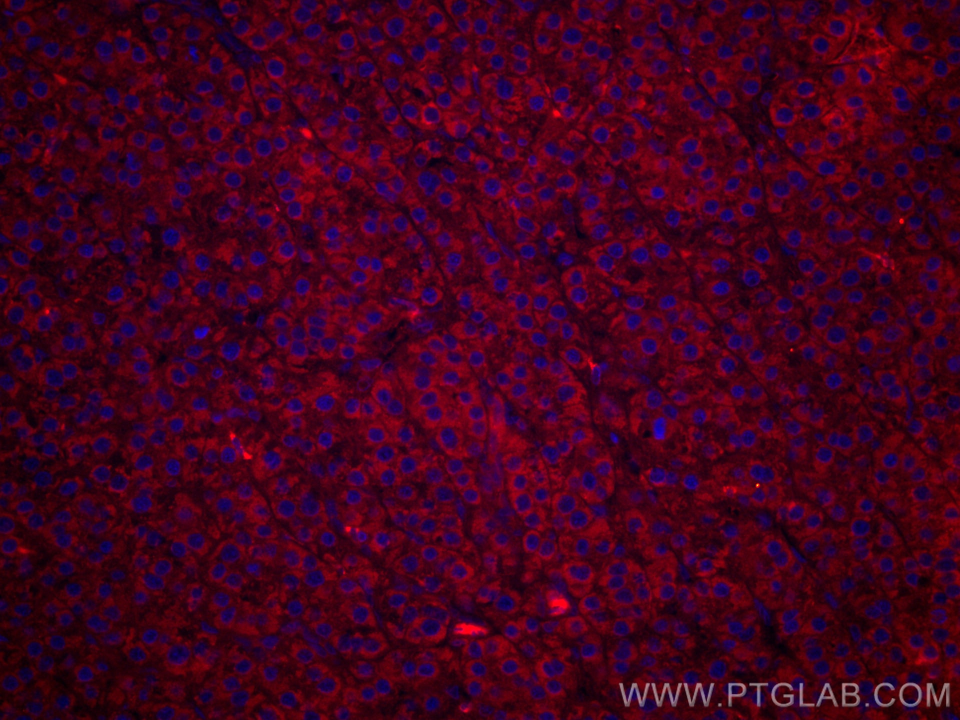 IF Staining of human liver cancer using CL594-60192