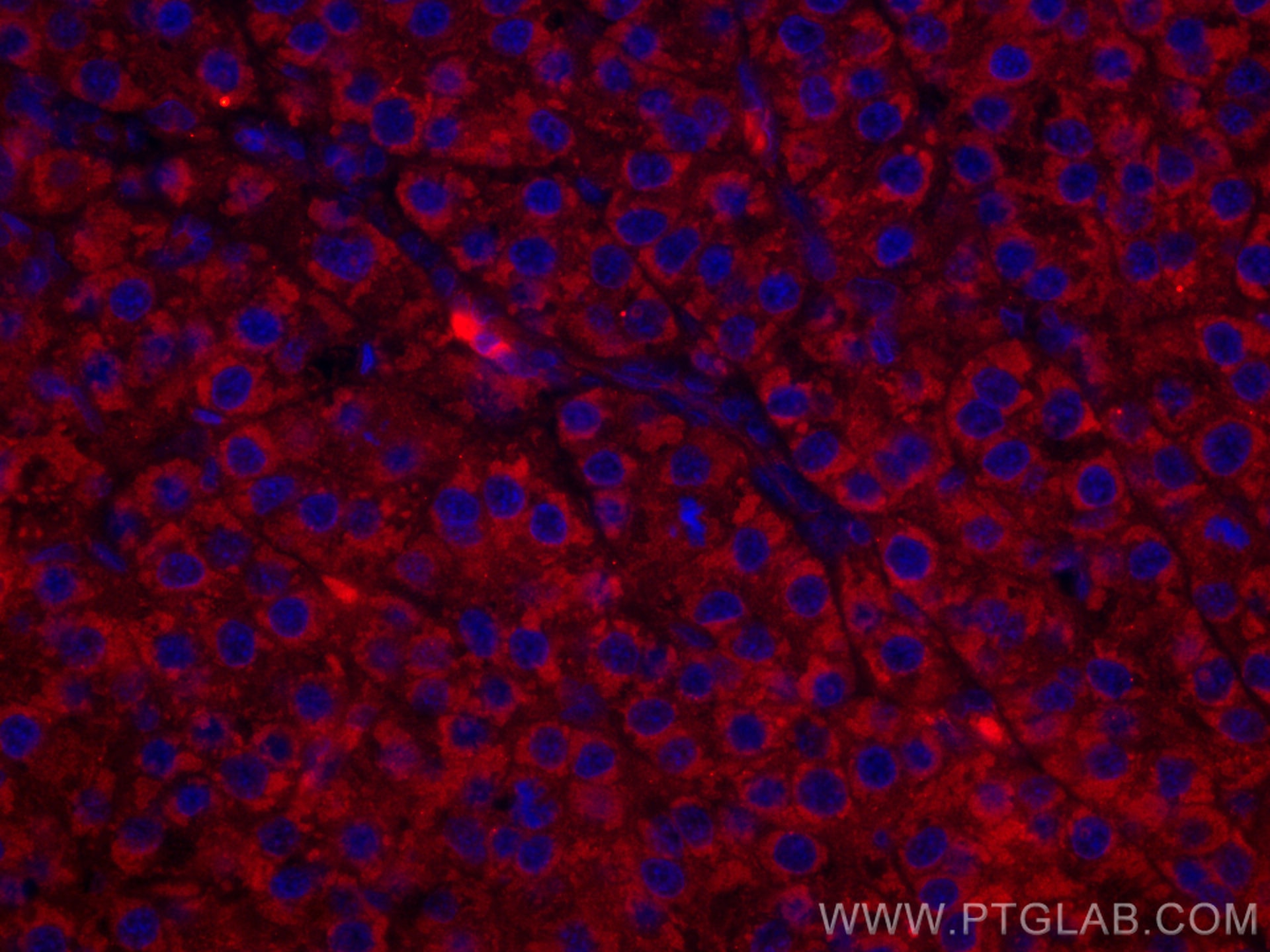 Immunofluorescence (IF) / fluorescent staining of human liver cancer tissue using CoraLite®594-conjugated TNFR1 Monoclonal antibody (CL594-60192)