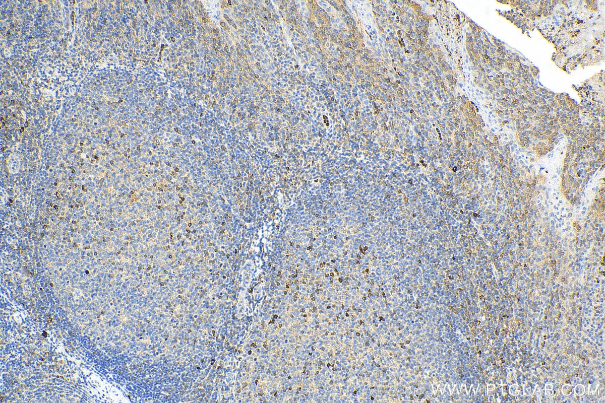 Immunohistochemistry (IHC) staining of human tonsillitis tissue using TNFR2 Polyclonal antibody (28746-1-AP)