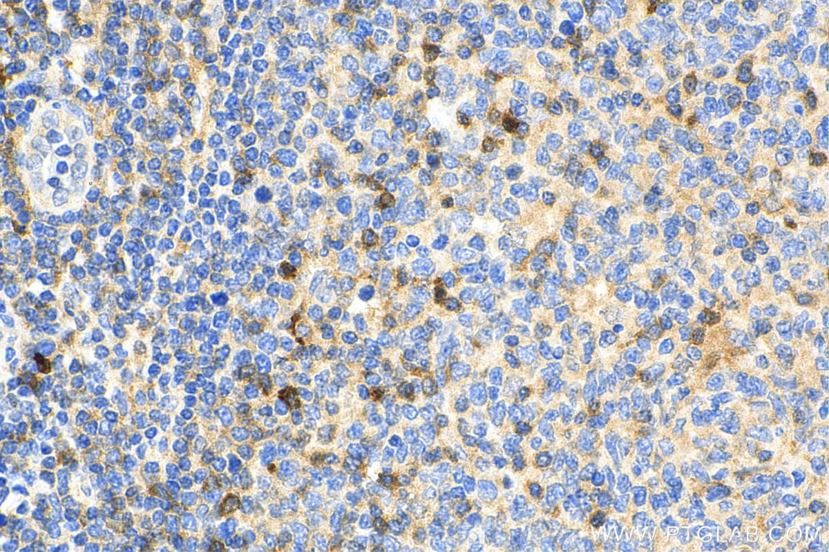 Immunohistochemistry (IHC) staining of human tonsillitis tissue using TNFR2 / TNFRSF1B Polyclonal antibody (28746-1-AP)