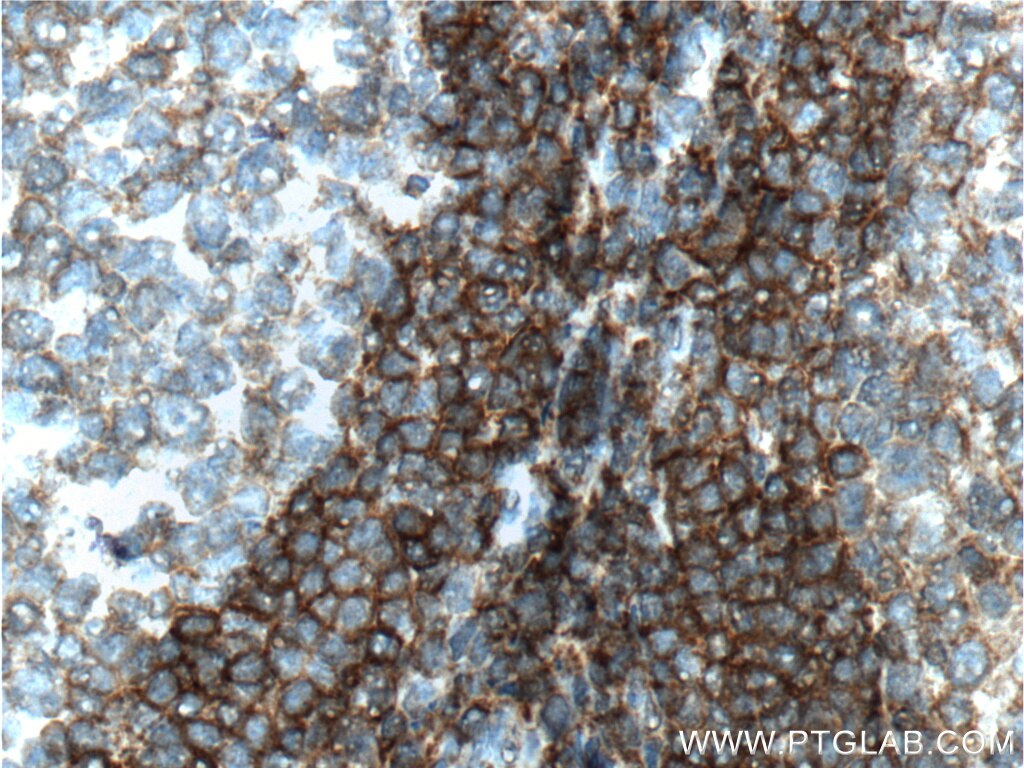 Immunohistochemistry (IHC) staining of human tonsillitis tissue using TNFRSF13C Polyclonal antibody (22582-1-AP)