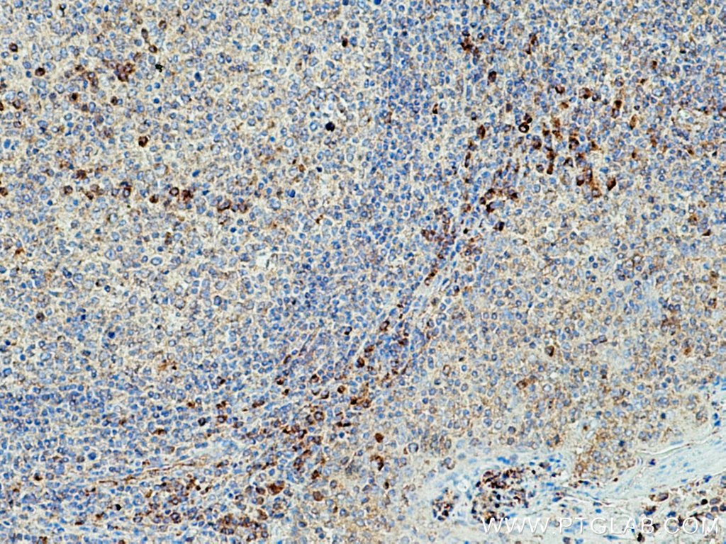 Immunohistochemistry (IHC) staining of human tonsillitis tissue using TNFRSF17 Polyclonal antibody (27724-1-AP)