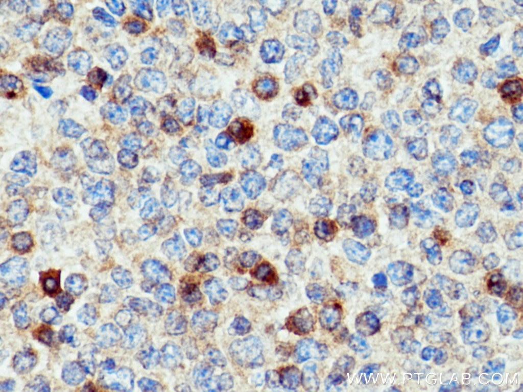 Immunohistochemistry (IHC) staining of human tonsillitis tissue using TNFRSF17 Polyclonal antibody (27724-1-AP)
