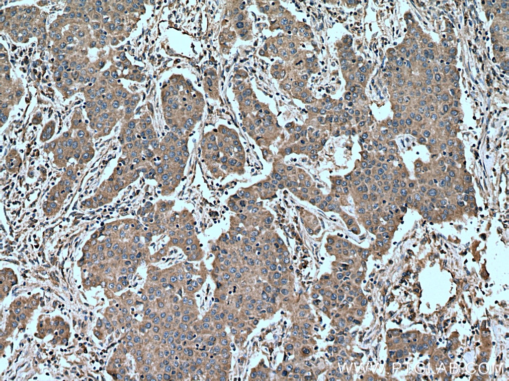 Immunohistochemistry (IHC) staining of human breast cancer tissue using TNFRSF17 Polyclonal antibody (27724-1-AP)