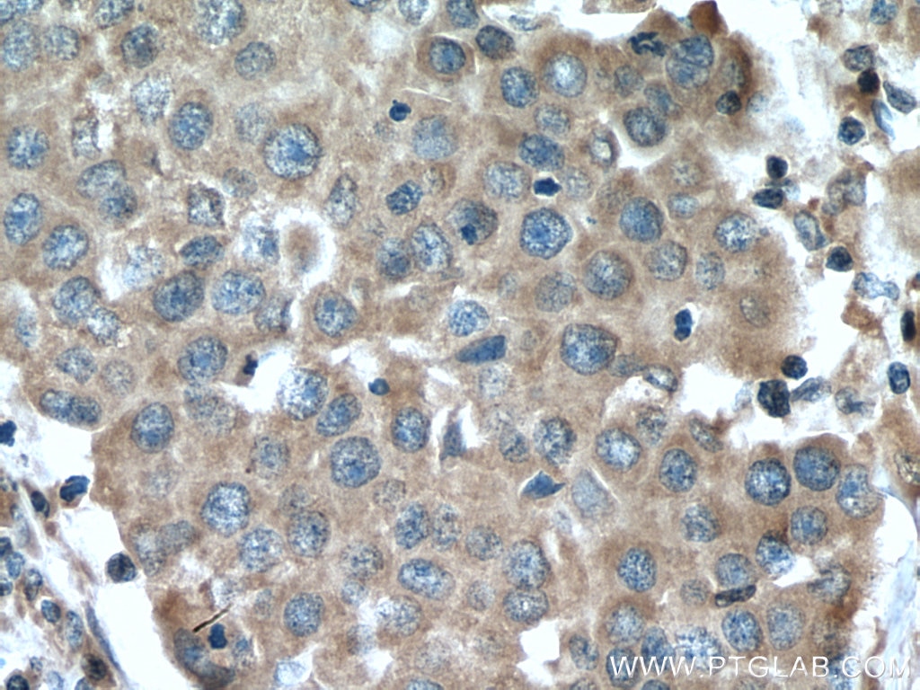 Immunohistochemistry (IHC) staining of human breast cancer tissue using BCMA/TNFRSF17 Polyclonal antibody (27724-1-AP)