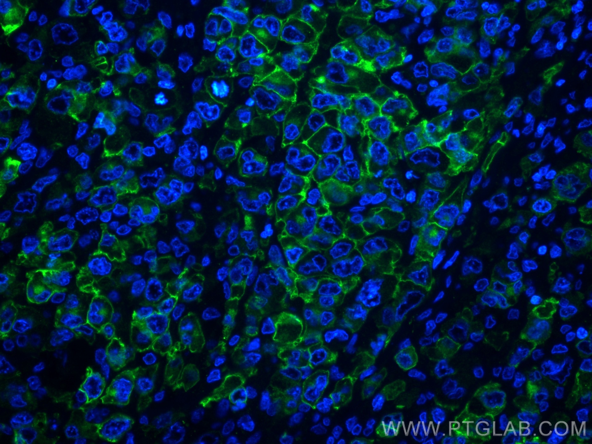 Immunofluorescence (IF) / fluorescent staining of human lymphoma tissue using CD30 Polyclonal antibody (55132-1-AP)