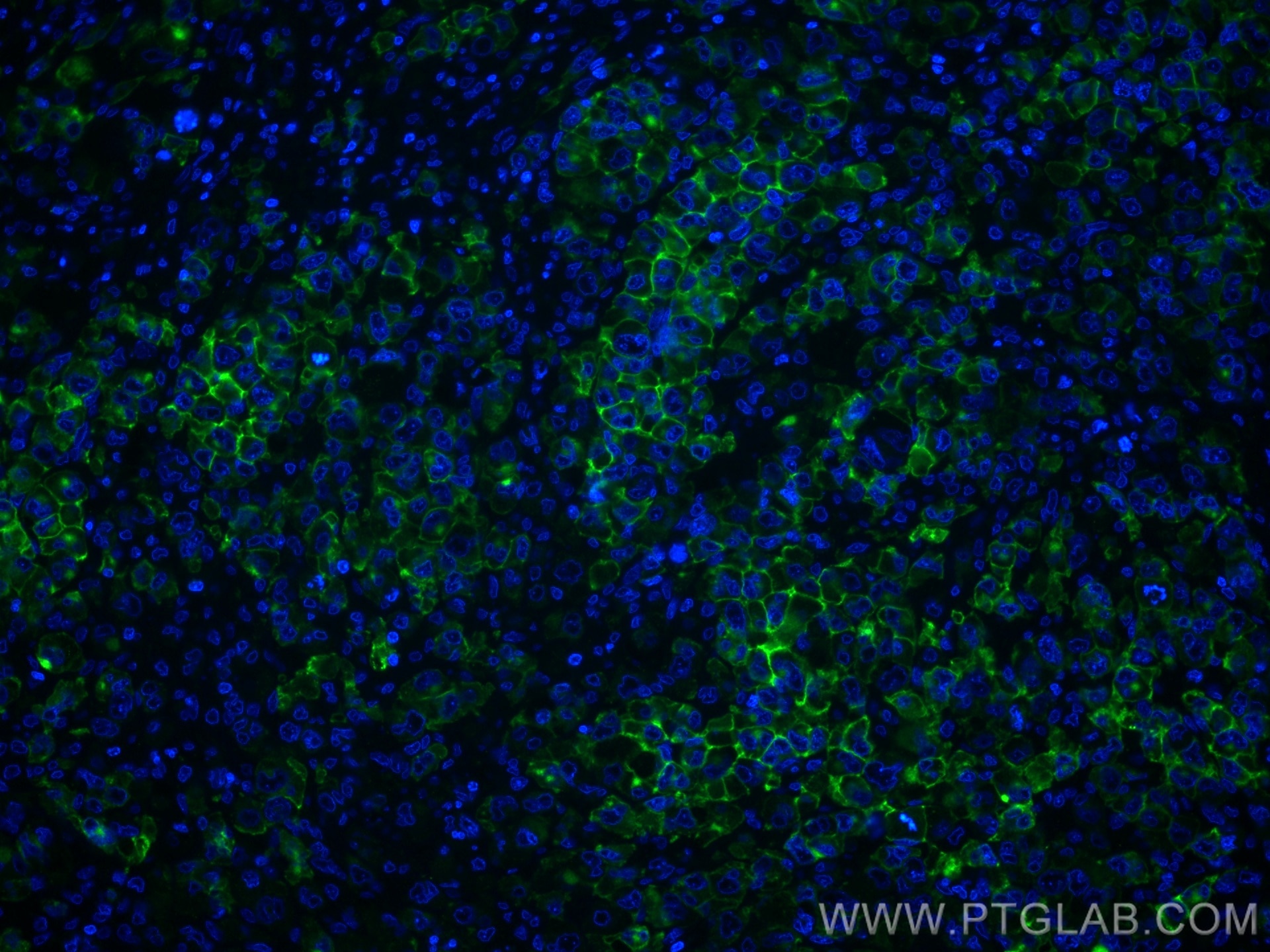 Immunofluorescence (IF) / fluorescent staining of human lymphoma tissue using CD30 Polyclonal antibody (55132-1-AP)