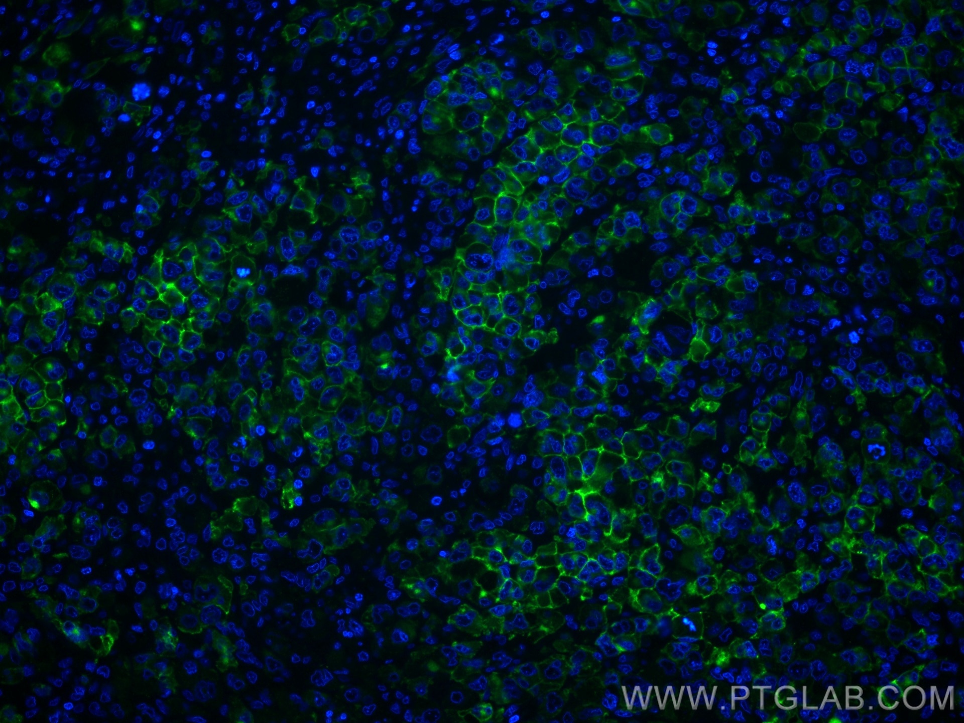 Immunofluorescence (IF) / fluorescent staining of human lymphoma tissue using CD30/TNFRSF8 Polyclonal antibody (55132-1-AP)