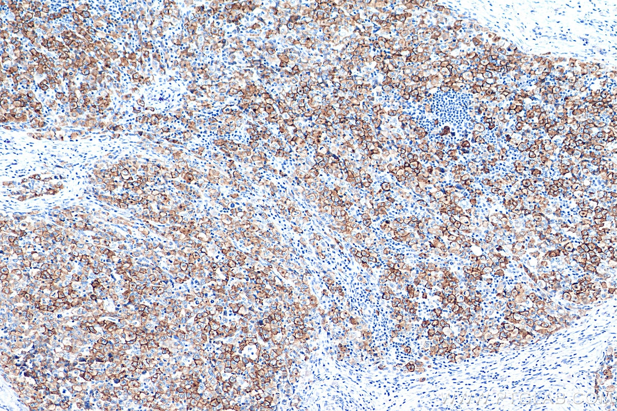 Immunohistochemistry (IHC) staining of human lymphoma tissue using CD30 Polyclonal antibody (55132-1-AP)