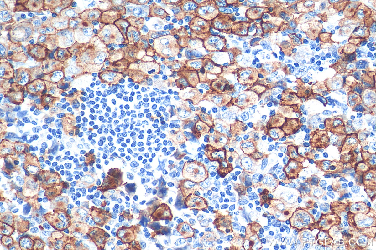 Immunohistochemistry (IHC) staining of human lymphoma tissue using CD30 Polyclonal antibody (55132-1-AP)