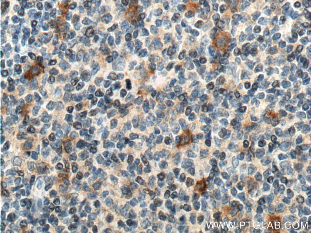 Immunohistochemistry (IHC) staining of human tonsillitis tissue using CD30 Polyclonal antibody (55132-1-AP)