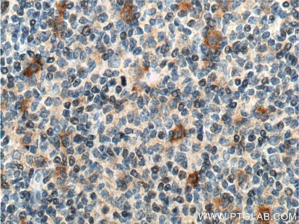 Immunohistochemistry (IHC) staining of human tonsillitis tissue using CD30 Polyclonal antibody (55132-1-AP)