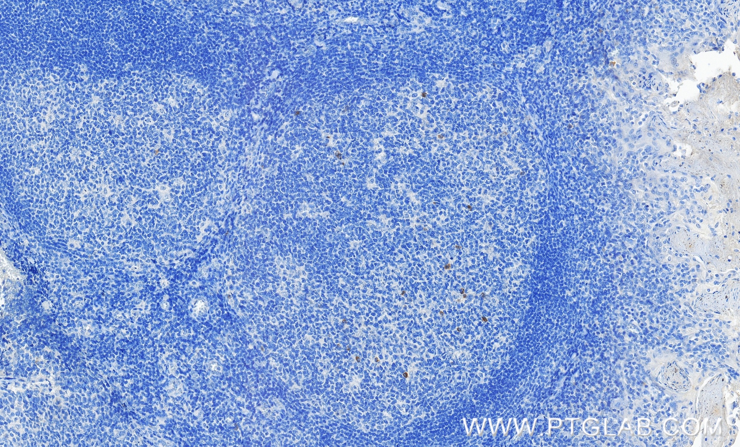 Immunohistochemical analysis of paraffin-embedded human tonsillitis tissue slide using 98112-1-RR (TNFRSF9/CD137 antibody) at dilution of 1:200 (under 40x lens). Heat mediated antigen retrieval with Tris-EDTA buffer (pH 9.0). This data was developed using the same antibody clone with 98112-1-PBS in a different storage buffer formulation. Immunohistochemistry (IHC) staining of human tonsillitis tissue using Anti-Human TNFRSF9/CD137 Rabbit Recombinant Antibo (98112-1-RR)
