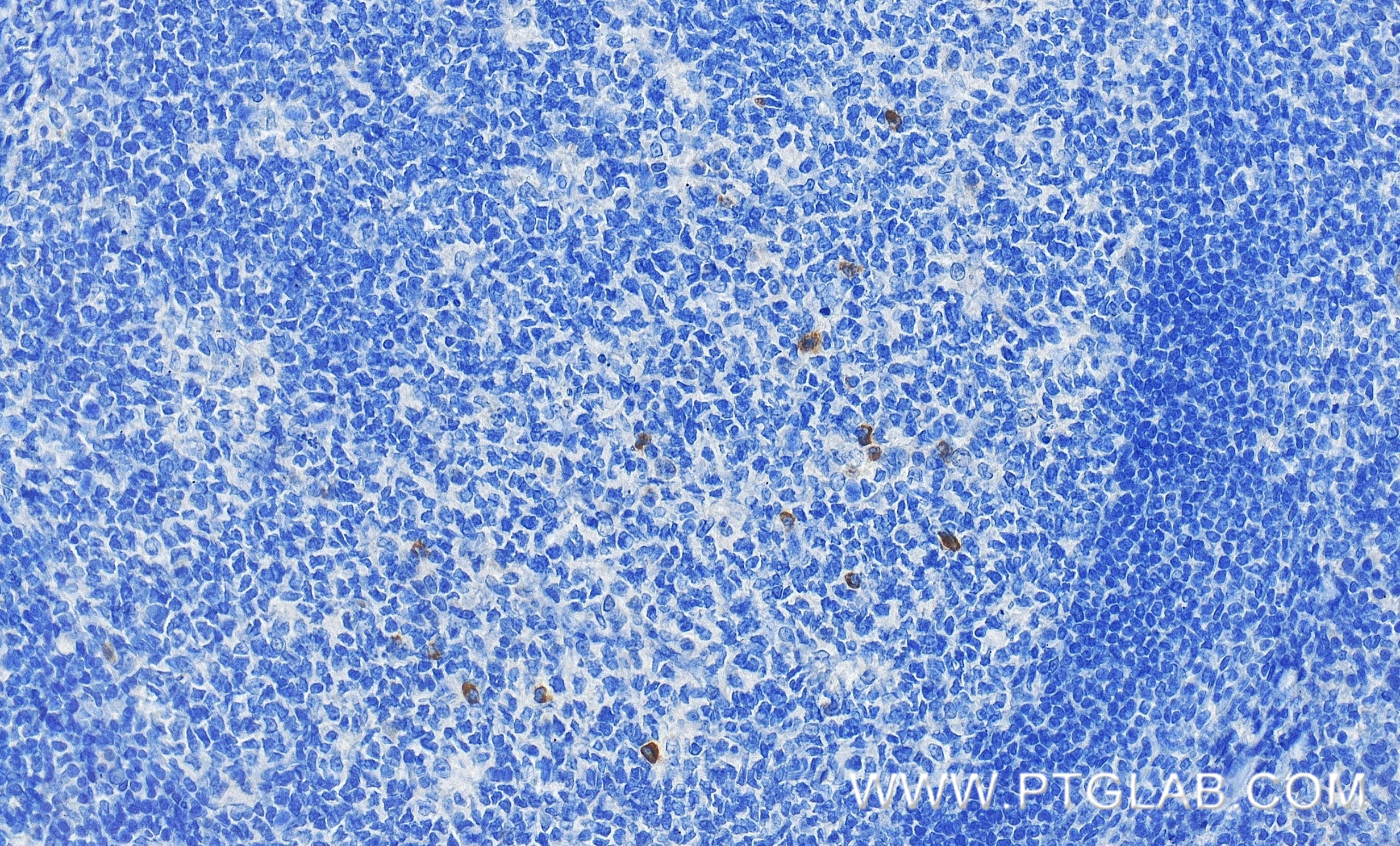 Immunohistochemical analysis of paraffin-embedded human tonsillitis tissue slide using 98112-1-RR (TNFRSF9/CD137 antibody) at dilution of 1:200 (under 40x lens). Heat mediated antigen retrieval with Tris-EDTA buffer (pH 9.0). This data was developed using the same antibody clone with 98112-1-PBS in a different storage buffer formulation. Immunohistochemistry (IHC) staining of human tonsillitis tissue using Anti-Human TNFRSF9/CD137 Rabbit Recombinant Antibo (98112-1-RR)