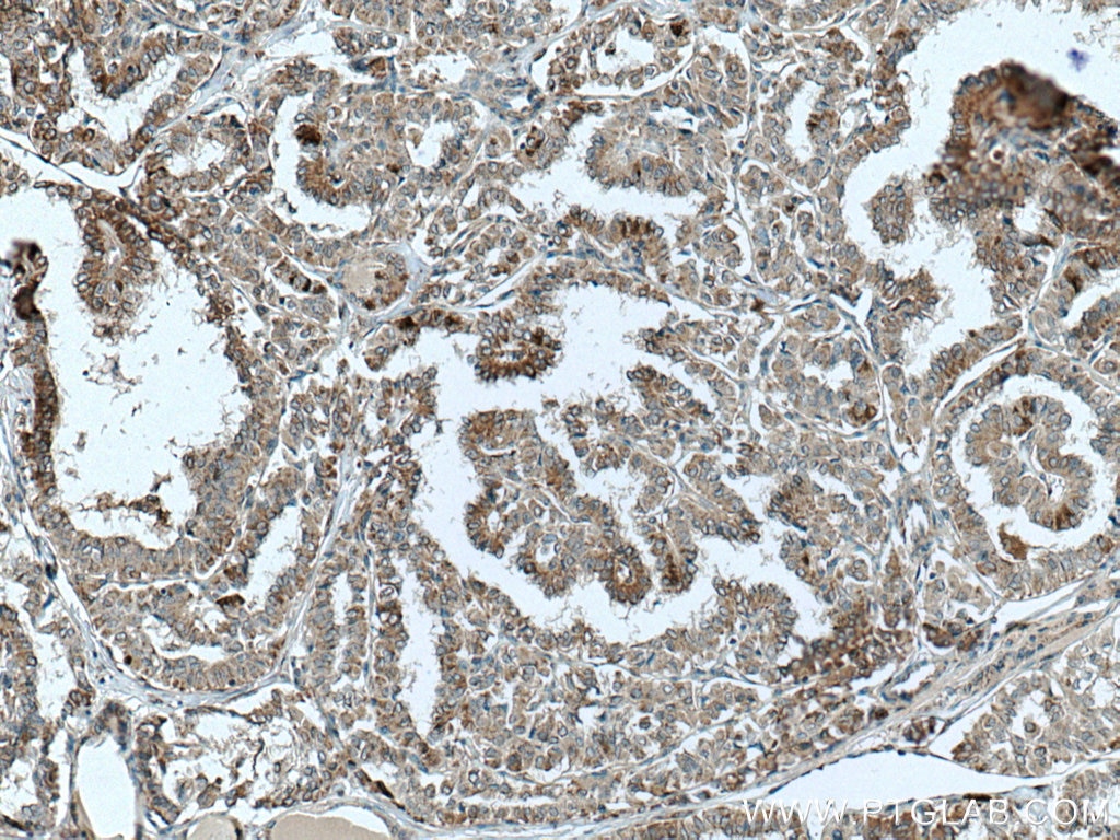 IHC staining of human thyroid cancer using 23899-1-AP