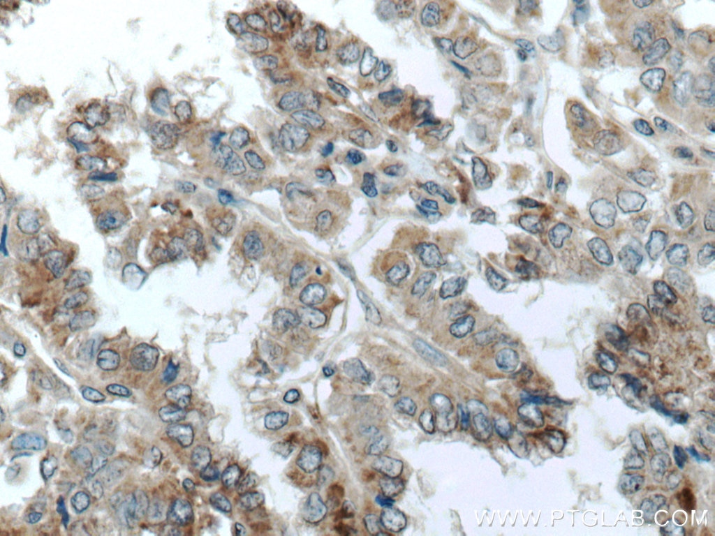 Immunohistochemistry (IHC) staining of human thyroid cancer tissue using TNFSF18 Polyclonal antibody (23899-1-AP)